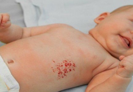 Причины, симптомы и лечение гемангиомы у новорожденных