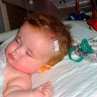 Симптомы и лечение гидроцефалии головного мозга у детей