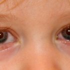 Причины красных глаз у ребёнка: конъюнктивит при простуде или другое заболевание?