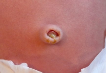 Если гноится пупок у грудничка: признаки омфалита у ребенка