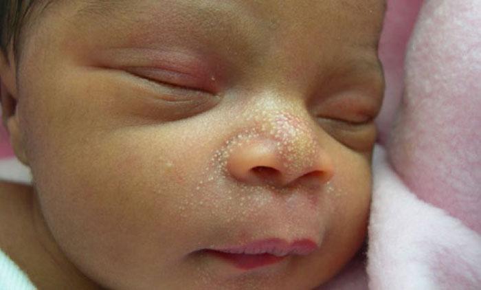 Милиумы (милии) на лице новорожденного