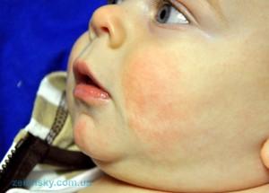 Витамин д вызывает аллергию у ребёнка