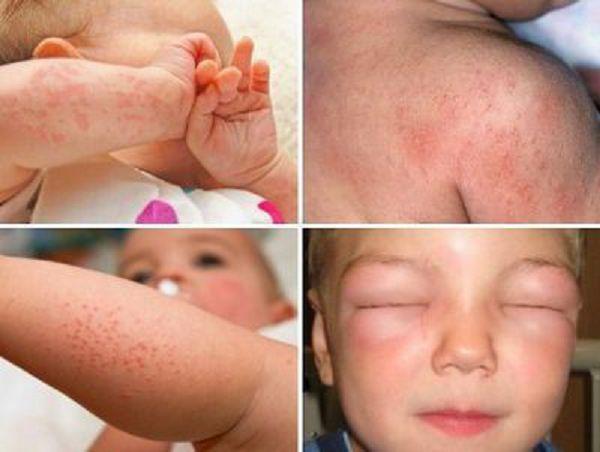 kak-vygljadit-allergija-u-detej